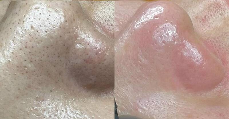 Chăm sóc da đúng cách giúp giảm sợi bã nhờn.