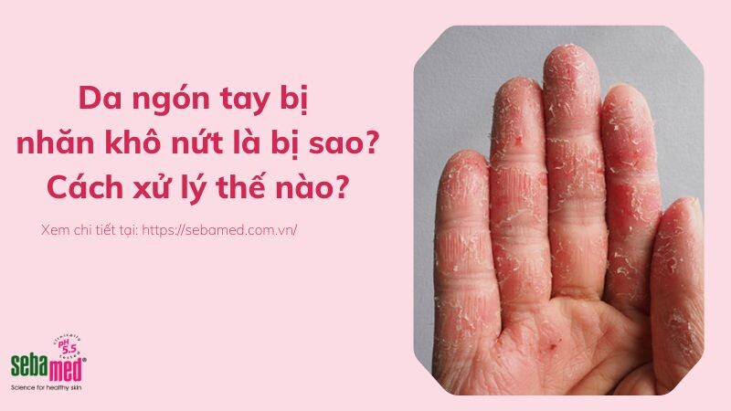 Da ngón tay bị nhăn khô nứt là bị sao, xử lý thế nào?