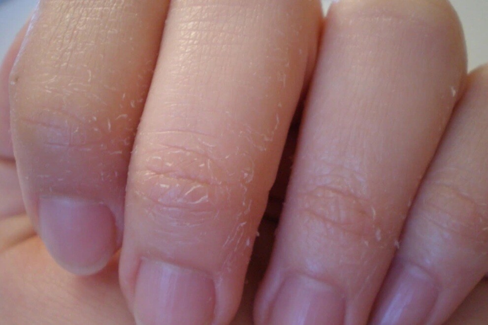 Da Tay Kho Nut Ne Chay Mau Khi Rua Bat Sebamed