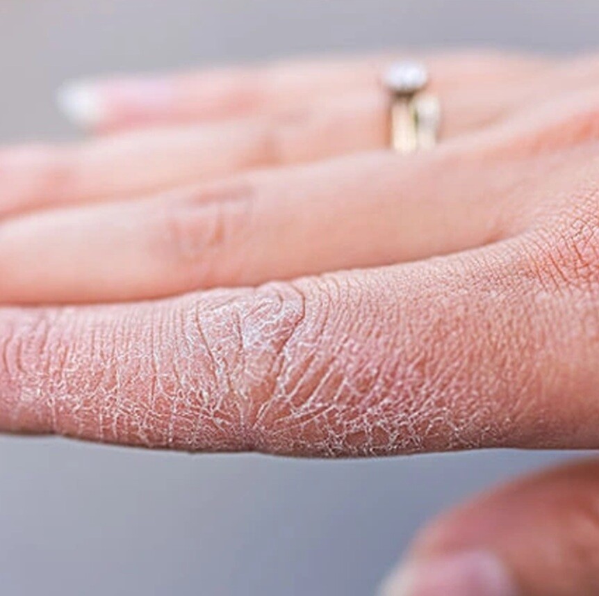 Da Tay Kho Nut Ne Chay Mau Sebamed