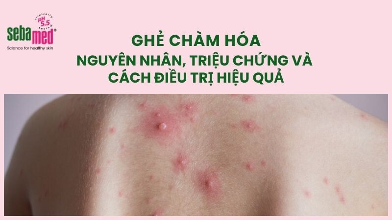 Ghẻ chàm hóa: Nguyên nhân, triệu chứng và cách điều trị hiệu quả