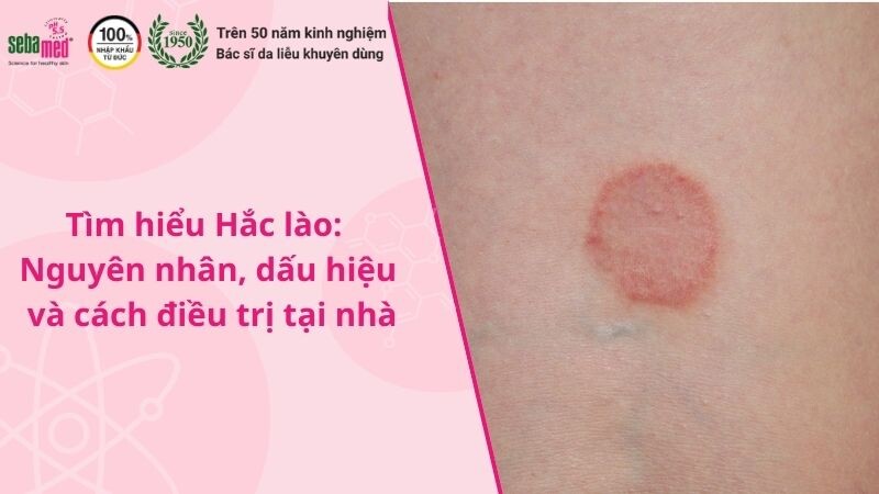 Hắc lào: Nguyên nhân, dấu hiệu và cách điều trị tại nhà