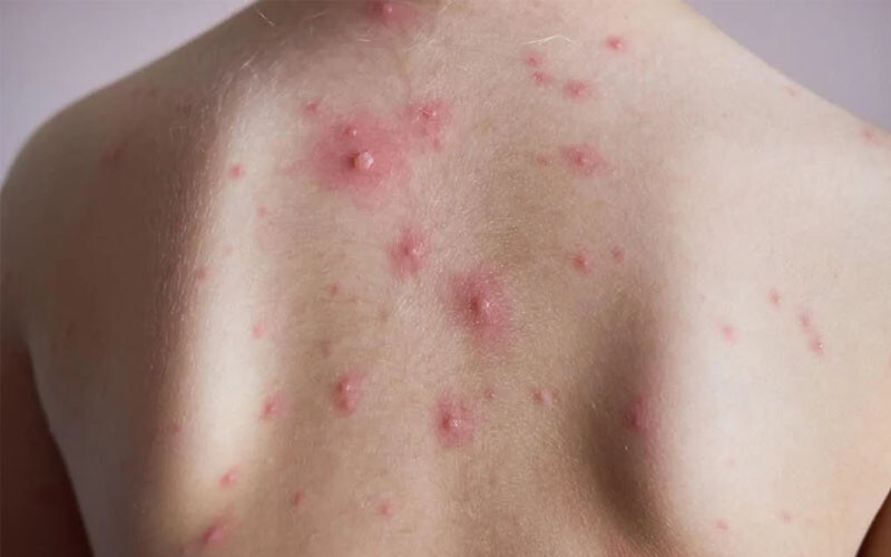 Lưng nổi mụn đỏ vì sao? Cách khắc phục nhanh chóng