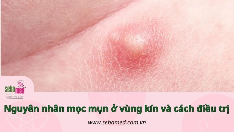 Mọc mụn ở vùng kín: Nguyên nhân và cách điều trị kịp thời