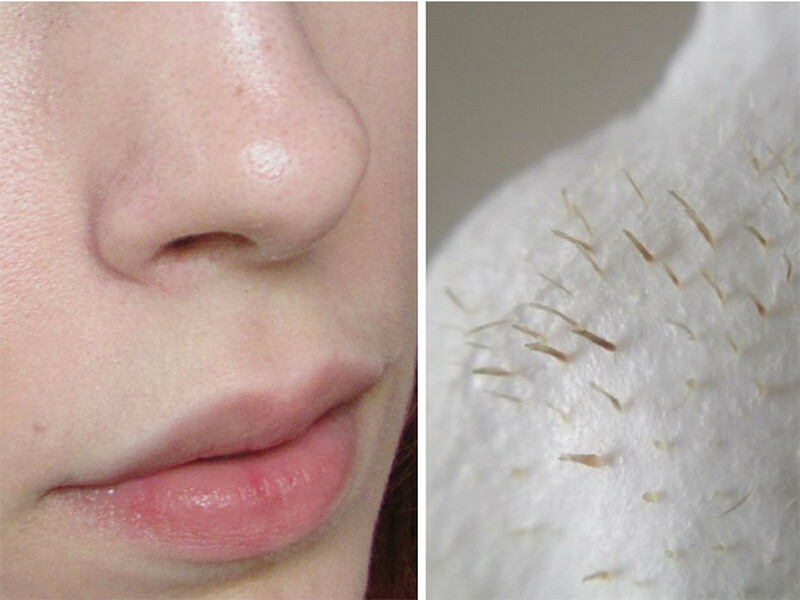 Nội tiết tố rồi loạn có thể khiến da tăng tiết bã nhờn, tạo điều kiện vi khuẩn gây mùi phát triển sinh ra sợi bã nhờn có mùi hôi.