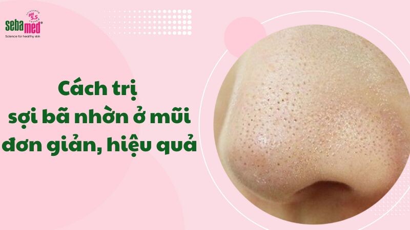 15+ cách trị sợi bã nhờn ở mũi ngay sau 1 đêm