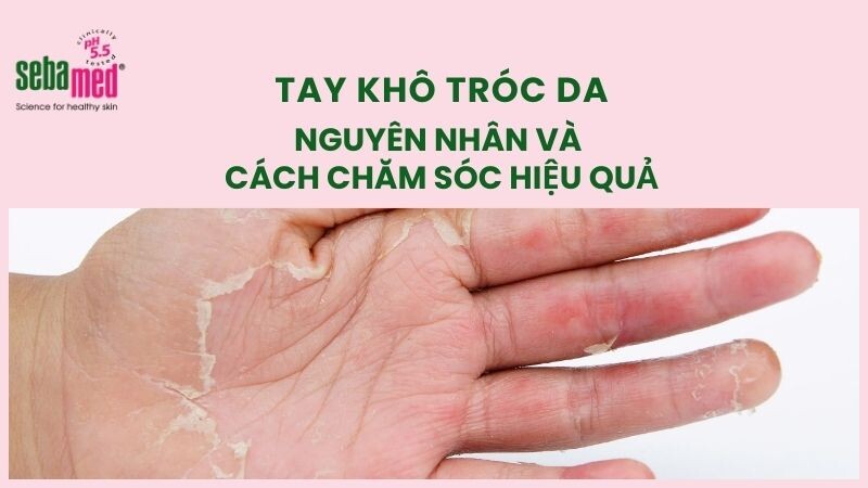 Tay khô tróc da: 14 Nguyên nhân và cách chăm sóc mềm da nhanh chóng