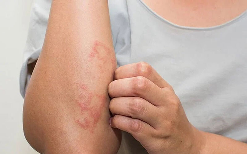 Viêm da tiếp xúc do côn trùng: Nguyên nhân và cách điều trị