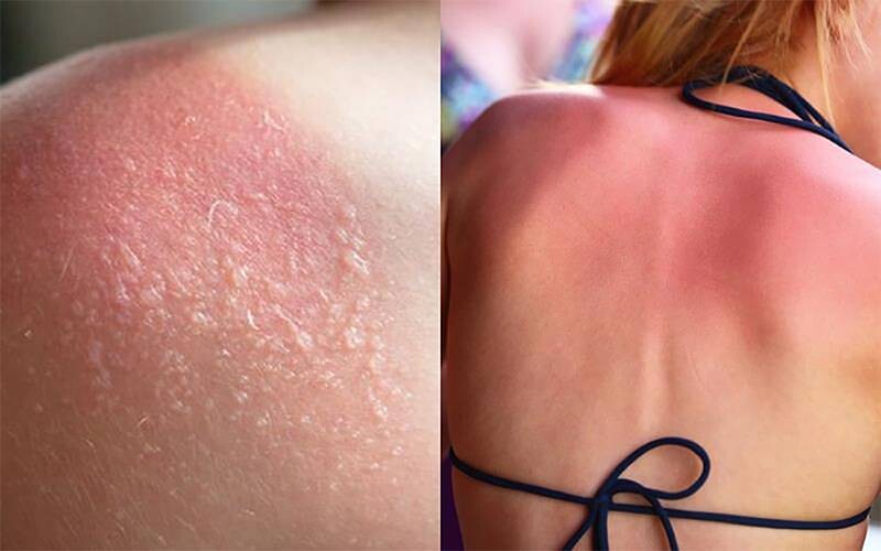 Mách bạn 10 cách phục hồi da bị cháy nắng nhanh nhất