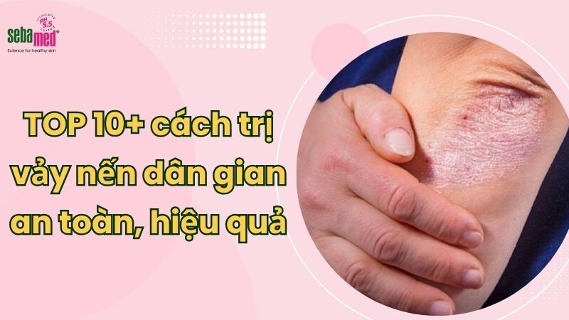 10+ cách trị vảy nến dân gian an toàn, đơn giản