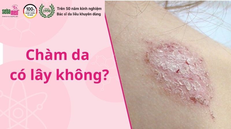 Chàm da có lây không?