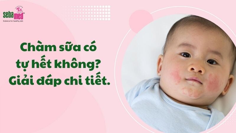 Chàm sữa có tự hết không? Giải đáp chi tiết để cha mẹ không hoang mang