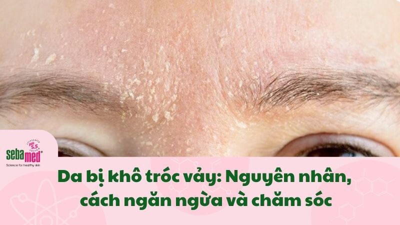 Da bị khô tróc vảy: Nguyên nhân, cách ngăn ngừa và chăm sóc
