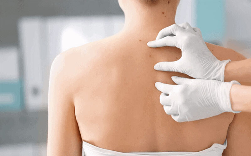 Xử lý mụn thịt ở lưng nhanh chóng, hiệu quả