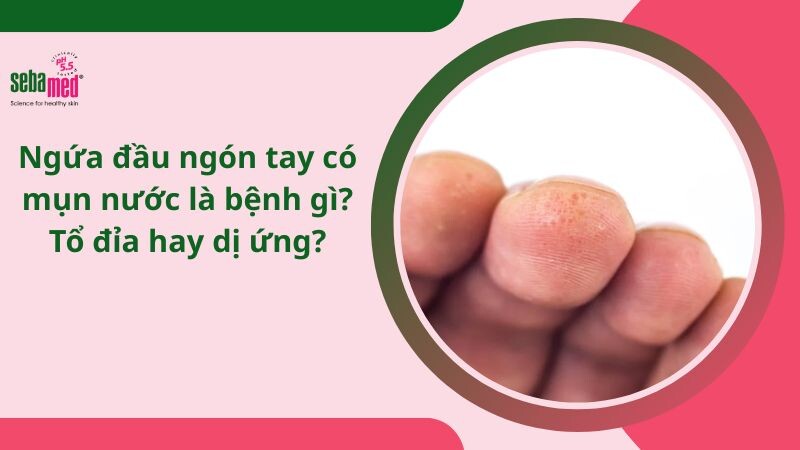 Ngứa đầu ngón tay có mụn nước là bệnh gì? Tổ đỉa hay dị ứng?