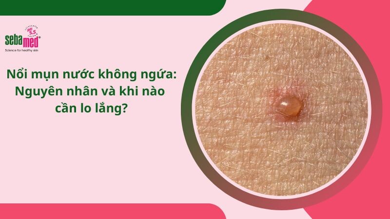 Nổi mụn nước không ngứa: Nguyên nhân và khi nào cần lo lắng?