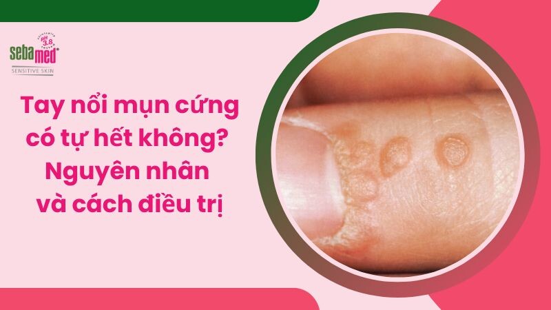 Tay nổi mụn cứng có tự hết không? Nguyên nhân và cách điều trị
