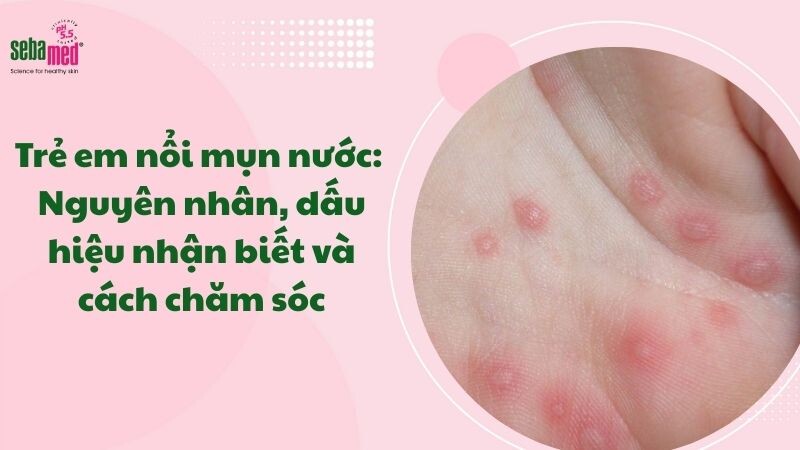 Trẻ em nổi mụn nước: Nguyên nhân, dấu hiệu nhận biết và cách chăm sóc an toàn