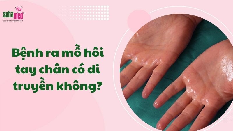 Bệnh ra mồ hôi tay chân có di truyền không?