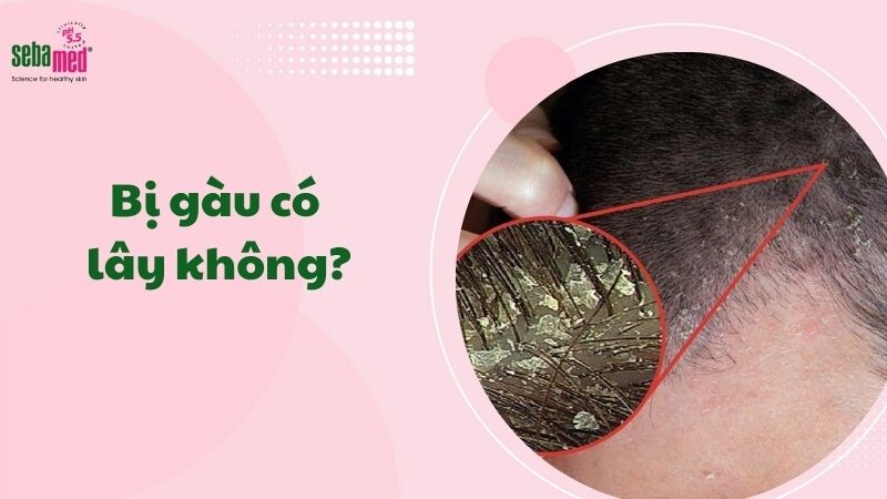 Bị gàu có lây không?