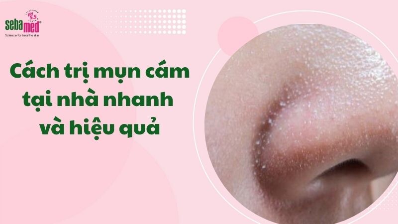 8+ Cách trị mụn cám tại nhà nhanh và hiệu quả