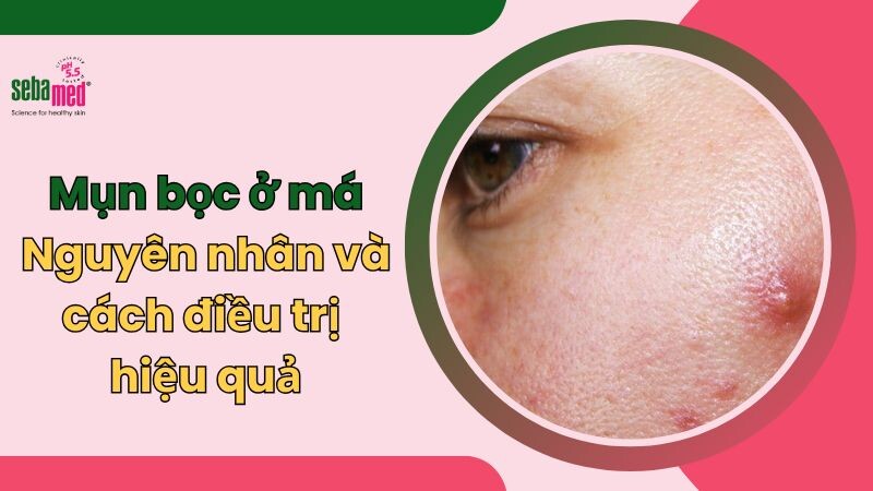 Mụn bọc ở má: Nguyên nhân và cách điều trị hiệu quả