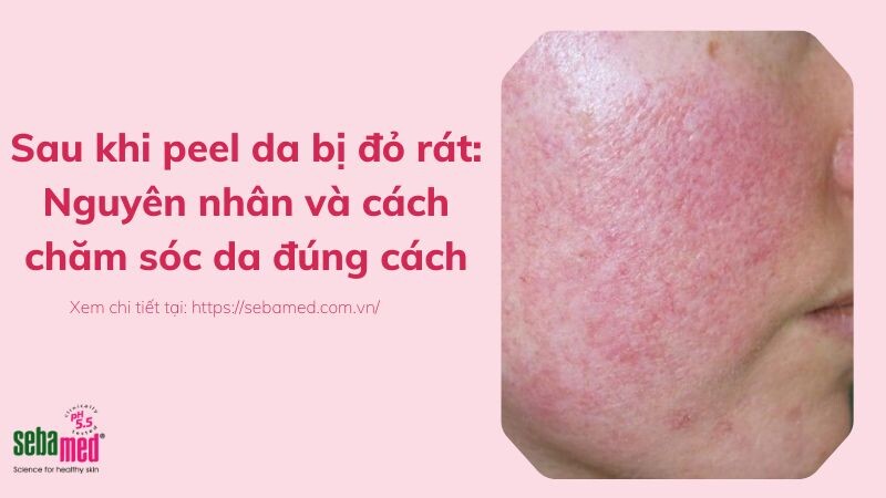 Sau khi peel da bị đỏ rát: Nguyên nhân và cách chăm sóc da đúng cách