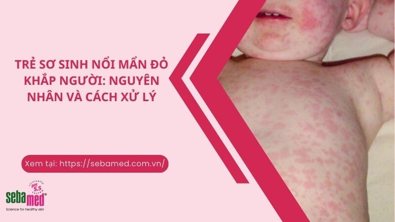 Trẻ sơ sinh nổi mẩn đỏ khắp người: Nguyên nhân và cách xử lý