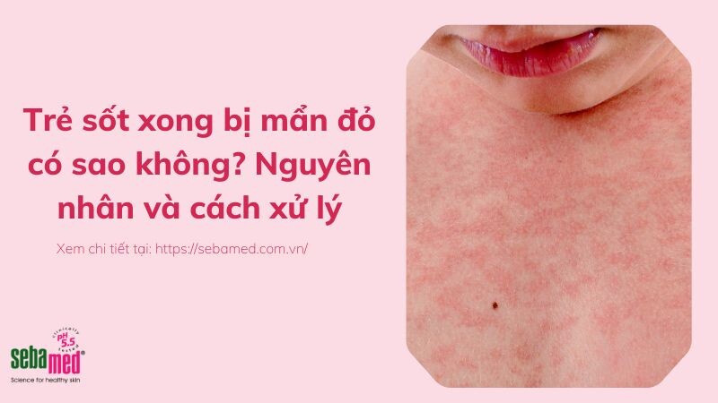 Trẻ sốt xong bị mẩn đỏ có sao không? Nguyên nhân và cách xử lý