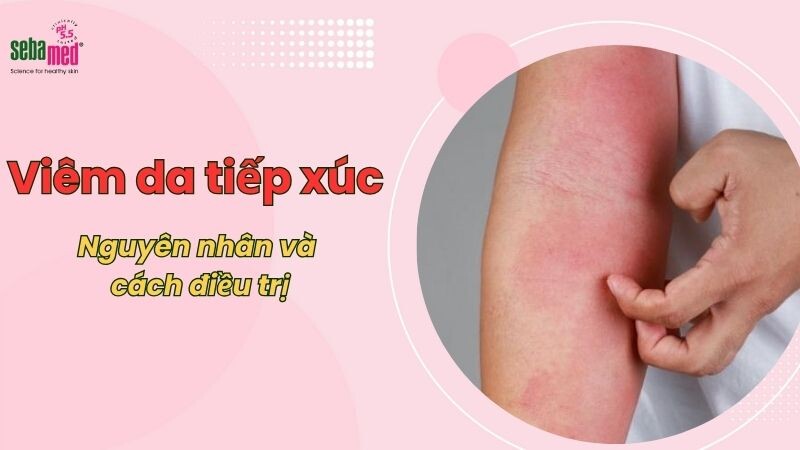 Viêm da tiếp xúc là gì? Nguyên nhân và cách điều trị